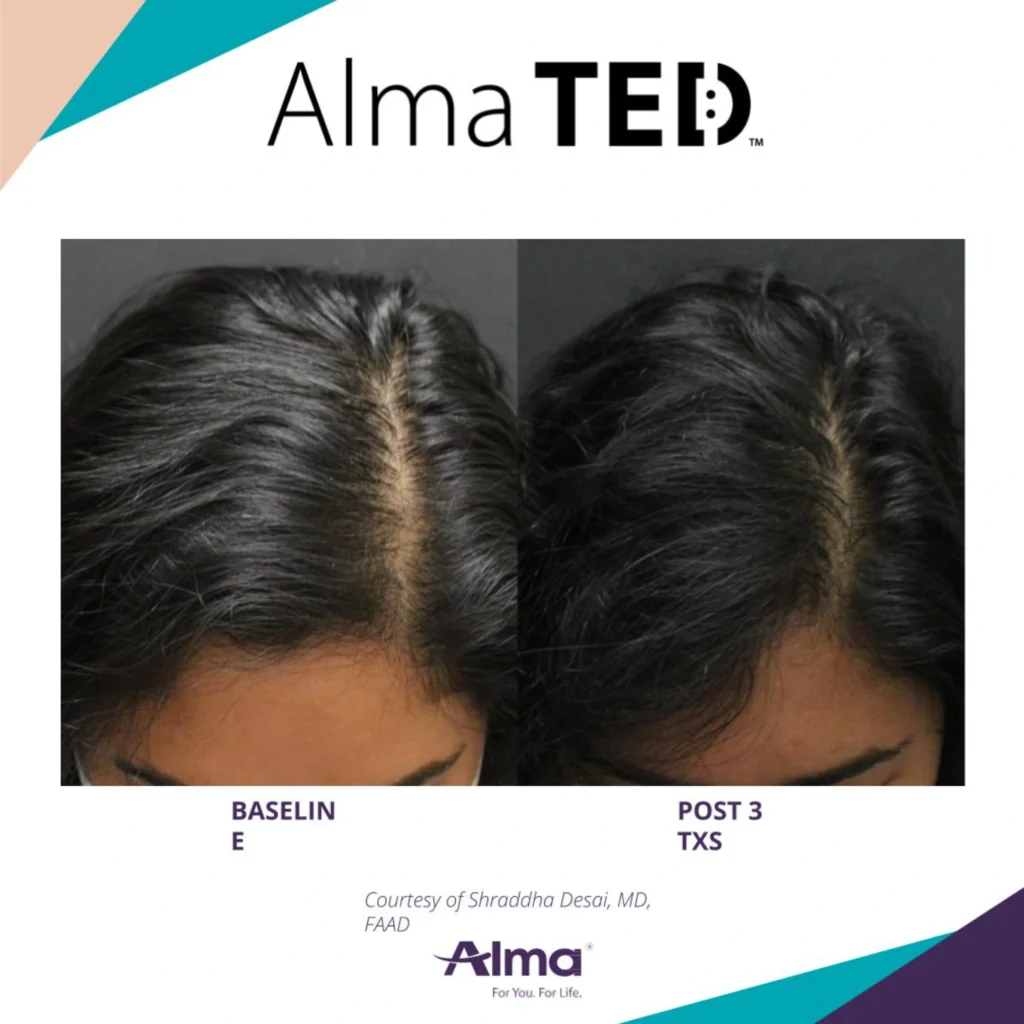 Hair Restoration Park City